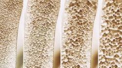 Perosi Catat 41,7 Persen Warga Kena Osteopenia, Ini Kunci Mencegah Osteoporosis Sejak Dini